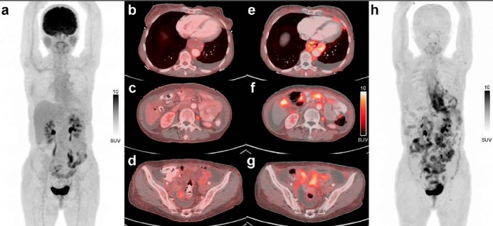 Impact of <sup>68</sup>Ga-FAPi PET/CT on Staging or Restaging Digestive System Tumors in Patients with Negative or Equivocal <sup>18</sup>F-FDG PET/CT Findings.