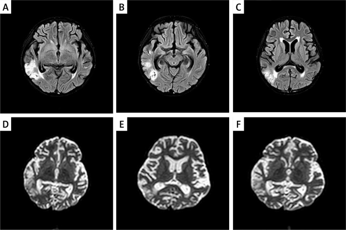 A novel heterozygous mutation in the gelsolin gene causes Finnish gelsolin amyloidosis associated with nephropathy and thrombotic microangiopathy.