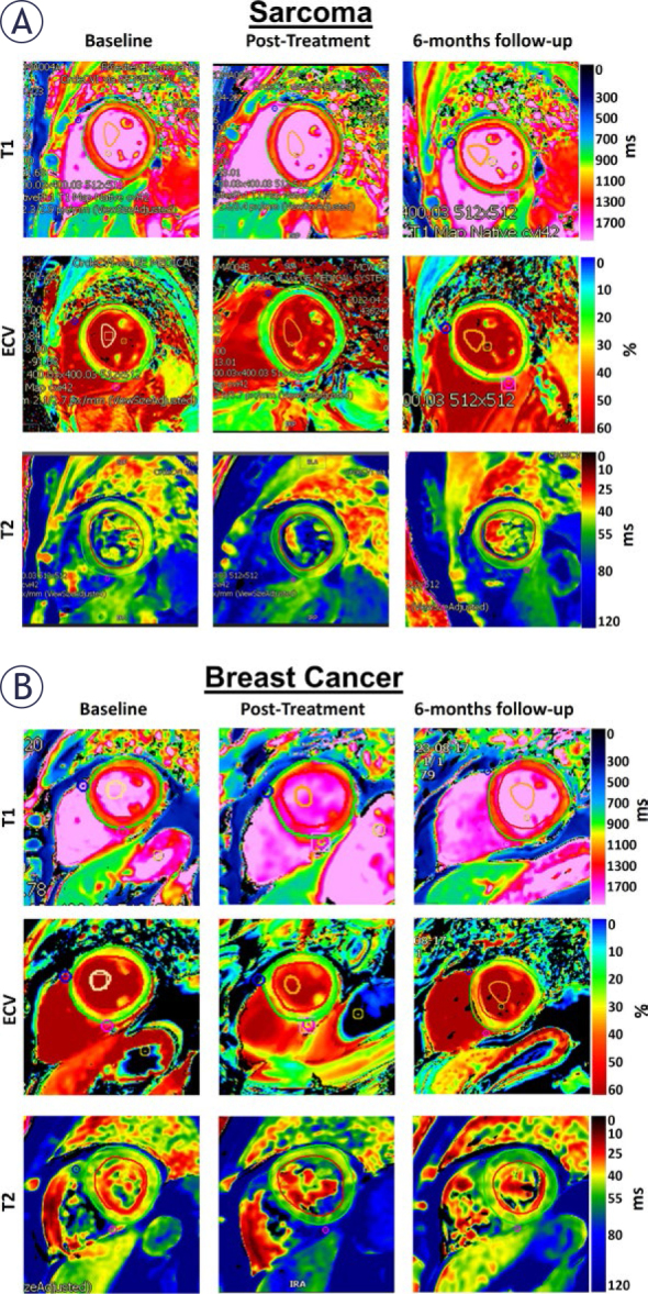 Cardiac MRI for differentiating chemotherapy-induced cardiotoxicity in sarcoma and breast cancer.