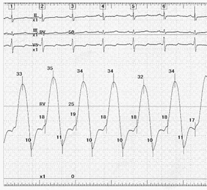Constrictive Pericarditis in a Hemodialysis Patient Who Presented with Rapidly Progressive Pericardial Calcification: A Diagnostic Challenge - A Case Report.