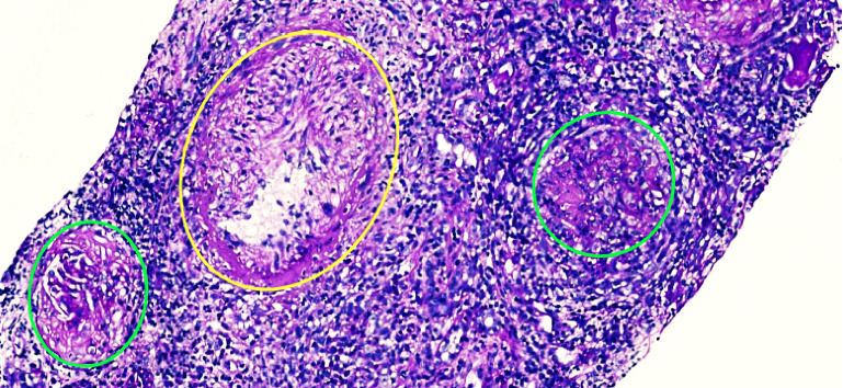 Overlap Syndrome in Late-Onset Systemic Lupus Erythematosus With Lupus Nephritis and MPO-ANCA Pauci-Immune Glomerulonephritis and Tuberculosis: An Uncommon Association.