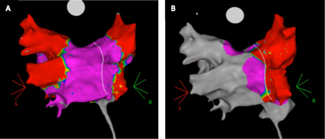 Feasibility and safety of zero-fluoro, "apron-less" approach to repeat pulmonary vein isolation procedures using radiofrequency energy after initial cryoballoon ablation.