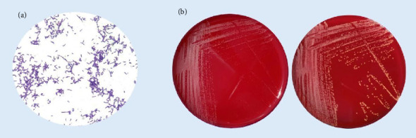 A Case of <i>Nocardia kroppenstedtii</i> Infection Successfully Treated With a Multidisciplinary Approach.