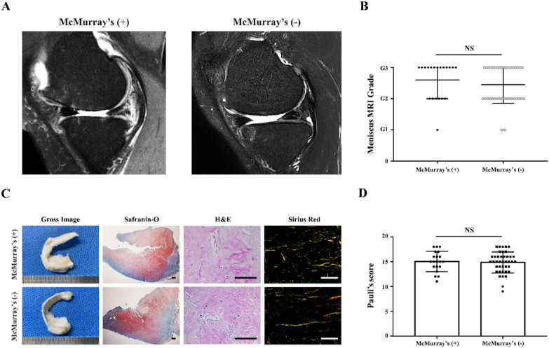 McMurray's test is influenced by perimeniscal synovitis in degenerative meniscus tears.
