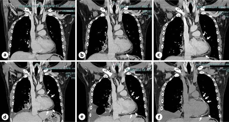 Constrictive Pericarditis in a Hemodialysis Patient Who Presented with Rapidly Progressive Pericardial Calcification: A Diagnostic Challenge - A Case Report.