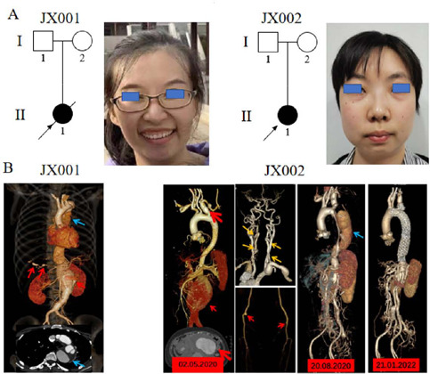 Identification of TGFBR1 Gene Variants in Two Chinese Pedigrees with Loeys-Dietz Syndrome.