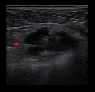 Spontaneous abdominal wall endometriosis: A case report.