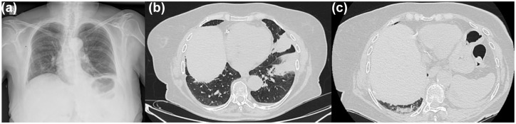 Pembrolizumab-induced myasthenia gravis with isolated diaphragmatic involvement in a lung cancer patient: a case report.