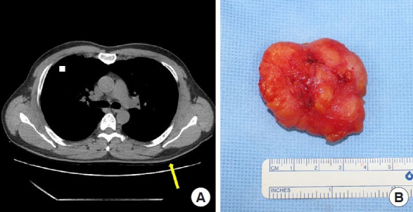 The diagnostic accuracy of depth prediction for lipomas by preoperative imaging with distribution according to anatomical site in Korea: a retrospective analysis.