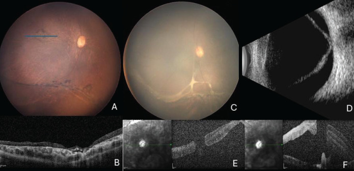 A Sandwich-Type Double-Layer Amniotic Membrane Graft for Repairing Myopic Macular Hole-Related Retinal Detachment in a Child with Knobloch Syndrome.