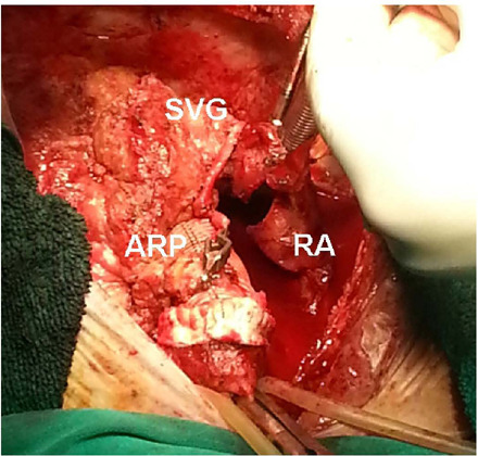 Early Acute Aortic Dissection After Coronary Artery Bypass Grafting.