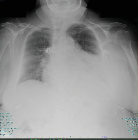 Hydralazine-Induced ANCA Vasculitis Presenting With Pericarditis: A Novel Case and Literature Review.