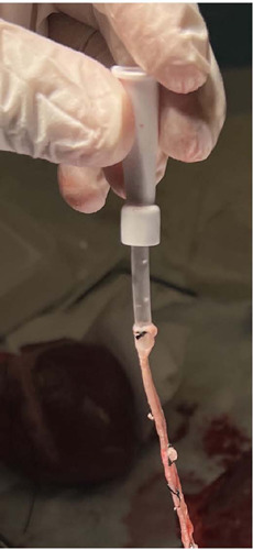 Comparison of Two Coronary Anastomosis Techniques in Terms of Flow Rate in Porcine Hearts.