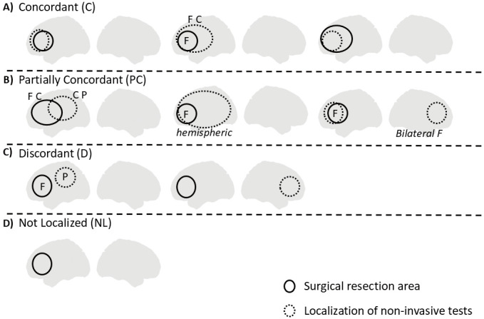 Prediction of Seizure Outcome Using Combinations of Four Noninvasive Presurgical Modalities in Magnetic Resonance Imaging-negative Focal Intractable Epilepsy.