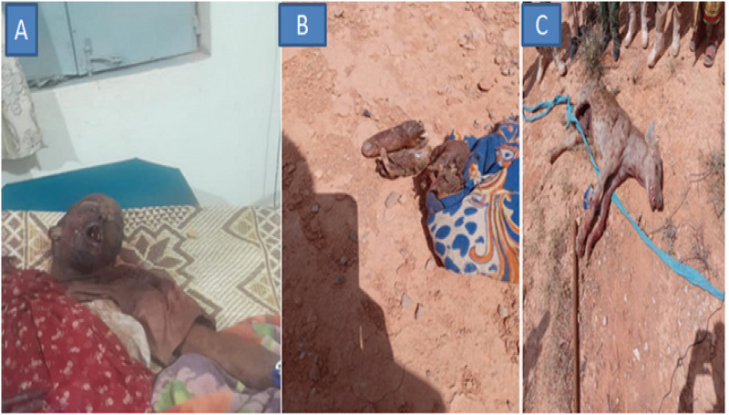 Deadly Injuries Sustained From a Hyena Attack: The Importance of Timely Diagnosis and Treatment - A Case Report.