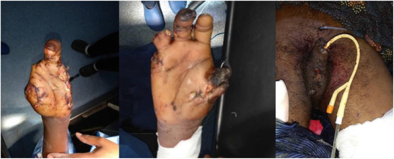 Deadly Injuries Sustained From a Hyena Attack: The Importance of Timely Diagnosis and Treatment - A Case Report.