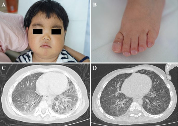 Interstitial Lung Disease in a Girl with Prolidase Deficiency.