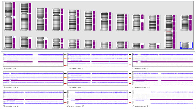 Whole genome uniparental isodisomy detected using single nucleotide polymorphism (SNP) microarray in molar pregnancy: a case report.