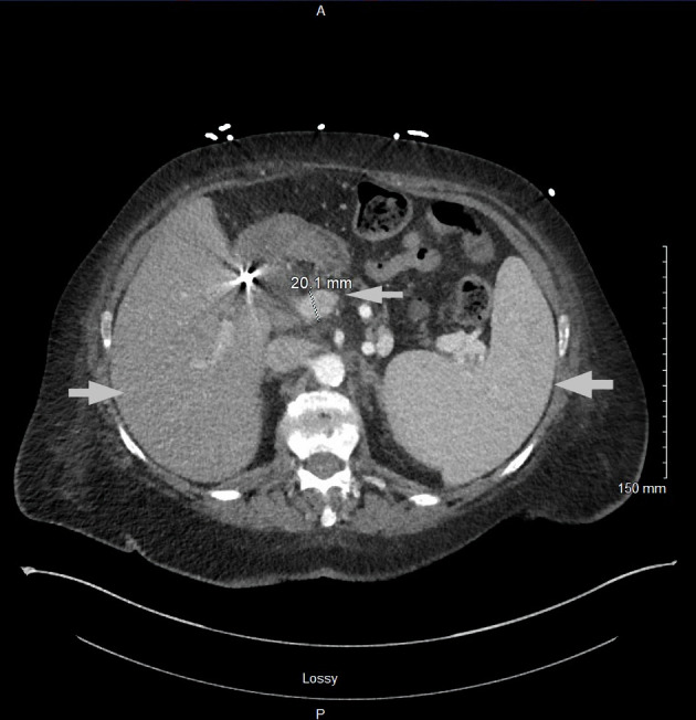 A Rare Case of Acute Aleukemic Mast Cell Leukemia With Osteoblastic Lesions in the Appendicular Skeleton.