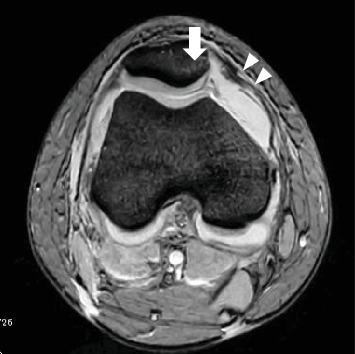 Osteochondral Fracture of the Posterior Aspect of Lateral Femoral Condyle Presumably Caused by Tibia Pushing Up Against the Femur-A Case Report.