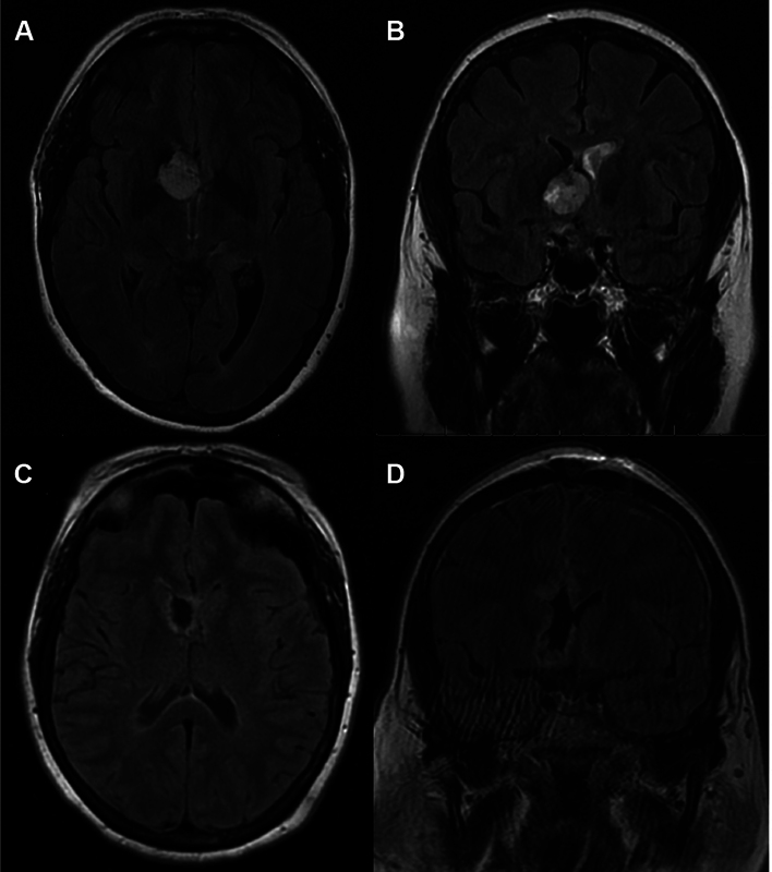Subependymal Giant Cell Astrocytoma in an Adult without Tuberous Sclerosis: Systematic Review and Illustrative Case Example.