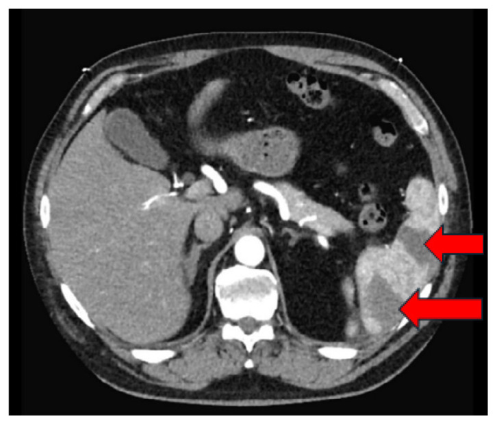 Working Backwards: Splenic Infarcts from Left Ventricular Thrombus.