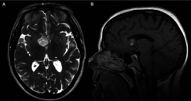 Subependymal Giant Cell Astrocytoma in an Adult without Tuberous Sclerosis: Systematic Review and Illustrative Case Example.
