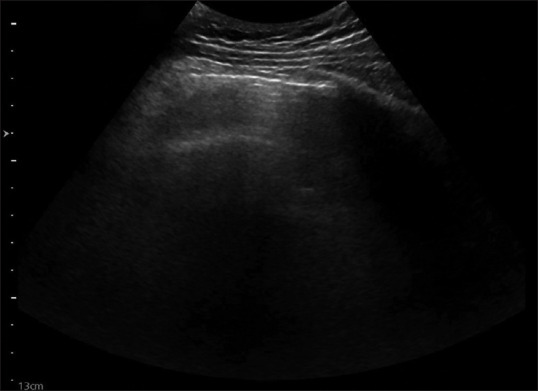 Yet another Case of Abdominal Pain.