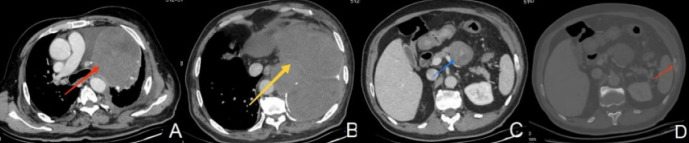 Primary Pulmonary Liposarcoma: A Case Report.