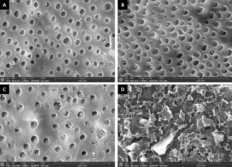 Occlusion, acid resistance, and elemental characterization of dentin treated with desensitizing agents.