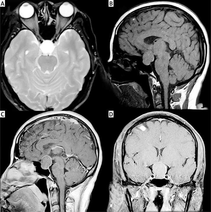 Effectiveness of endoscopic transnasal pituitary surgery versus antibiotic therapy in the management of pituitary abscess: a report of two cases.