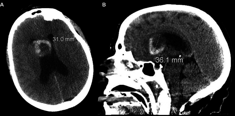 Subependymal Giant Cell Astrocytoma in an Adult without Tuberous Sclerosis: Systematic Review and Illustrative Case Example.