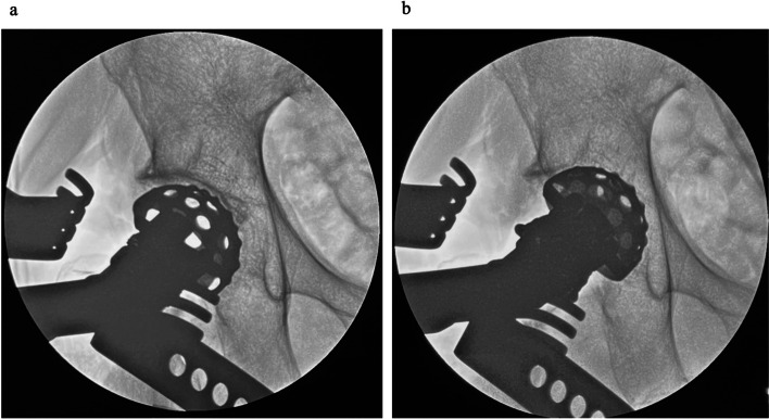 Optimizing implant positioning in total hip arthroplasty via the direct anterior approach: The role and technique of conventional traction table and fluoroscopy.