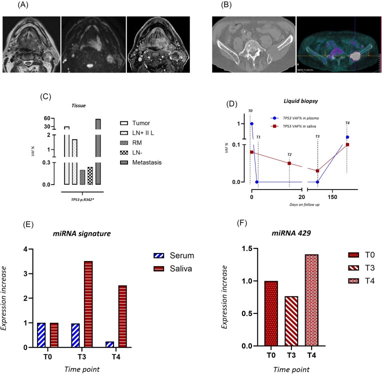 Liquid biopsy in head and neck cancer patients: blood, saliva, or both ?