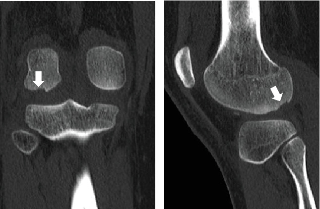 Osteochondral Fracture of the Posterior Aspect of Lateral Femoral Condyle Presumably Caused by Tibia Pushing Up Against the Femur-A Case Report.