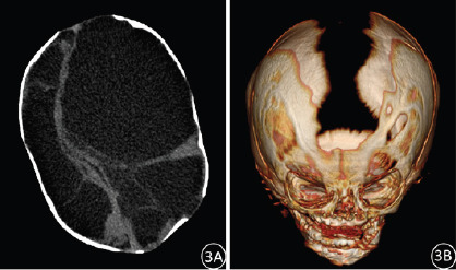 Hydranencephaly: exploring the role of CT features in the diagnosis of 22 cases.