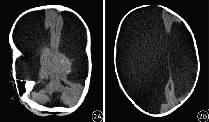 Hydranencephaly: exploring the role of CT features in the diagnosis of 22 cases.