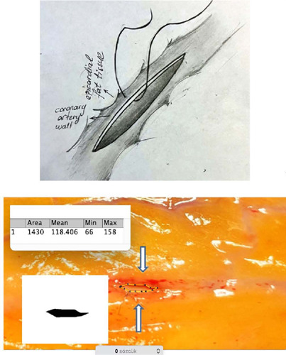Comparison of Two Coronary Anastomosis Techniques in Terms of Flow Rate in Porcine Hearts.