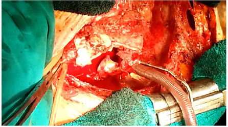 Early Acute Aortic Dissection After Coronary Artery Bypass Grafting.