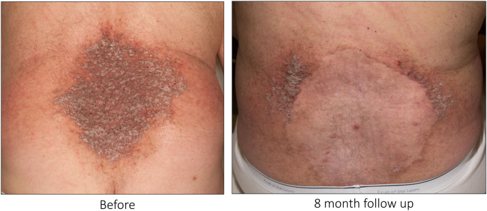 Carbon dioxide laser treatment for Darier disease