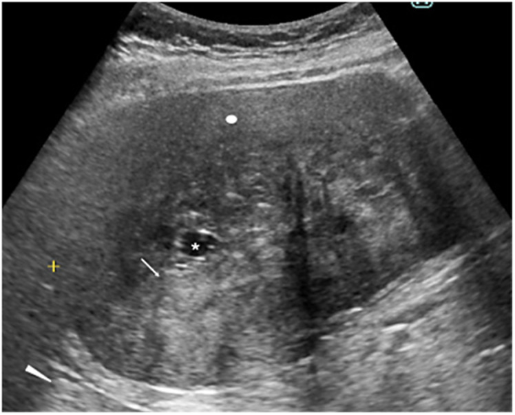 An Intra-Abdominal Desmoid Tumor with Edematous Loose Collagen Fibers.