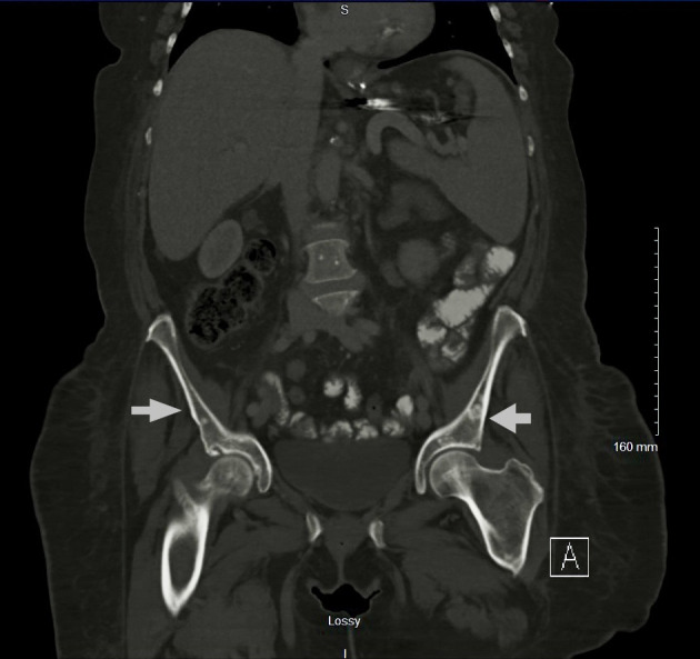 A Rare Case of Acute Aleukemic Mast Cell Leukemia With Osteoblastic Lesions in the Appendicular Skeleton.