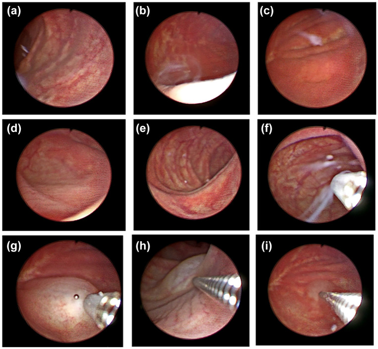 Endoscopic injection of botulinum toxin to prevent pouch contractions in a patient with Indiana pouch diversion.