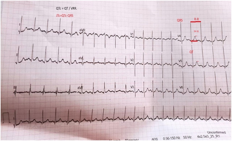 Impact of Different Metabolic Indicators on Ventricular Repolarization Indices in Obese Children: A Case Control Study.