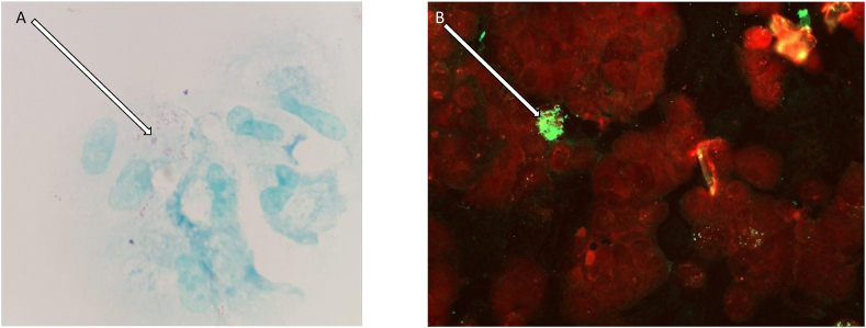 First reported breast implant infection due to Coxiella burnetii near an aerodrome in Southern France