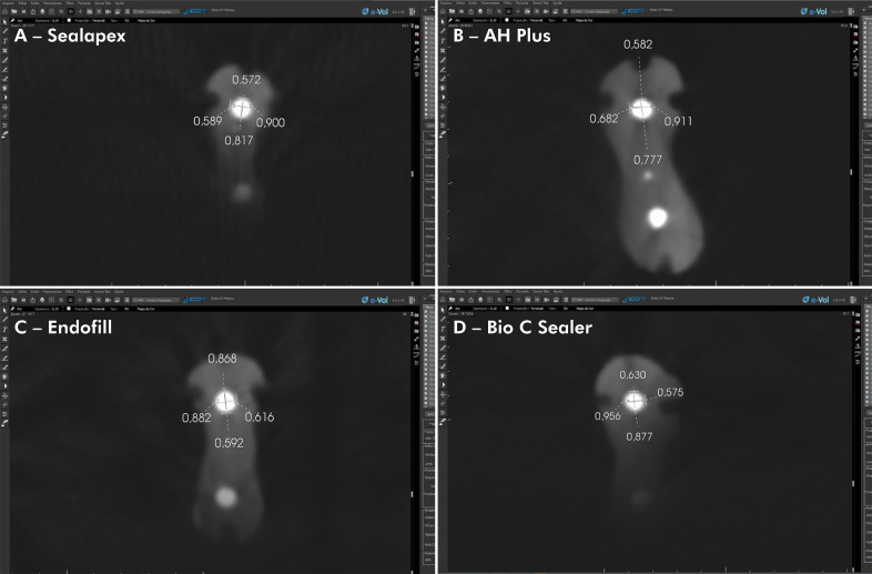 Application of artifact suppression algorithm of post-processing CBCT software in root canal filling materials.