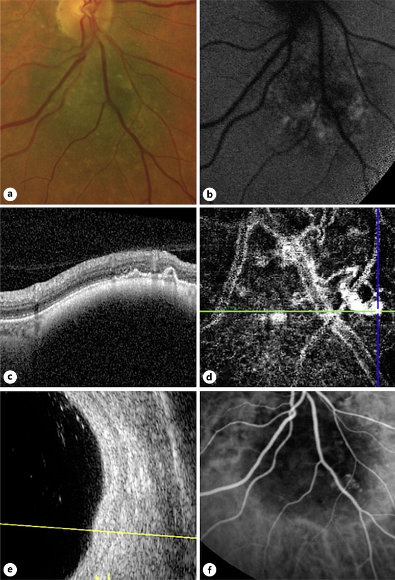 Six Cases of Polypoidal Choroidal Vasculopathy in Eyes with Choroidal Nevi.