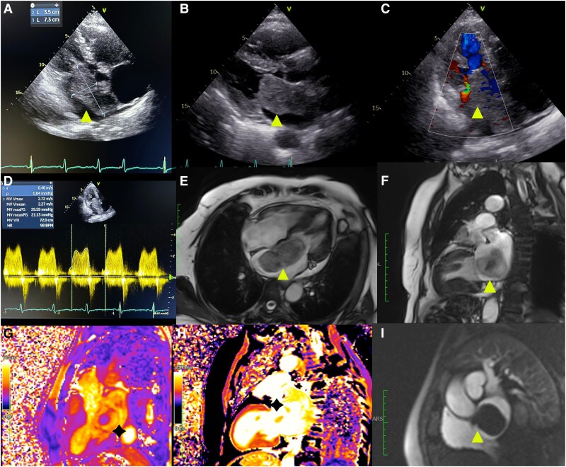 An unanticipated cause of worsening dyspnoea: mitral stenosis induced by cardiac myxoma.