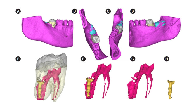 An unusual case of dens invaginatus on a mandibular second molar: a case report.