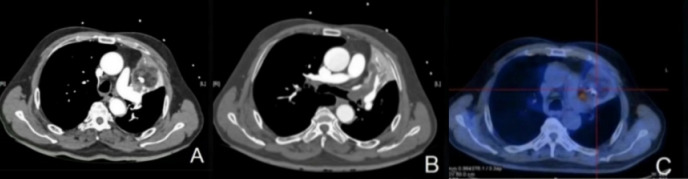 Primary Pulmonary Liposarcoma: A Case Report.